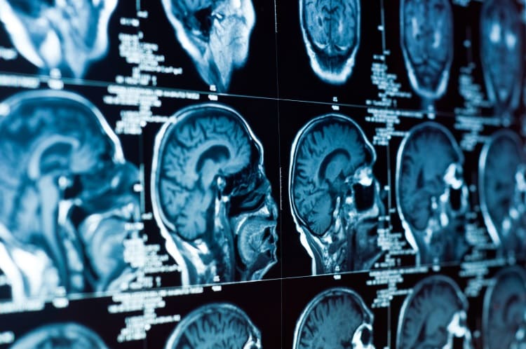 Ρευματοειδής αρθρίτιδα: Πώς οι χρόνιες φλεγμονές επιδρούν στον εγκέφαλο