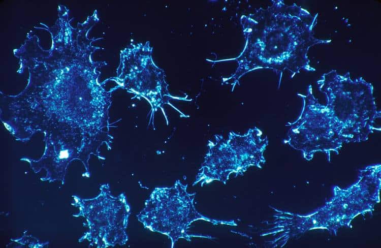 Νέα εξέταση υπόσχεται ανίχνευση του καρκίνου μέσα σε μόλις 10 λεπτά