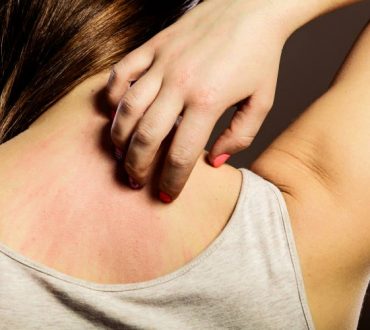 Αλλεργική αντίδραση: Ποια είναι τα συμπτώματα που χρειάζεται να προσέξουμε
