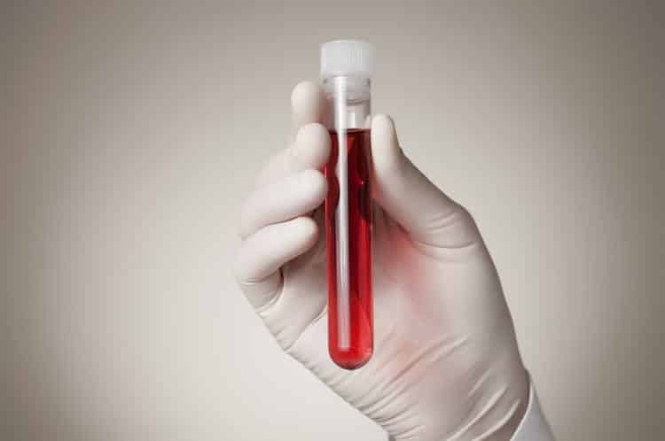 Νέα εξέταση αίματος εντοπίζει τον καρκίνο των ωοθηκών έως και δύο χρόνια νωρίτερα