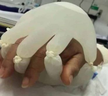 «Το χέρι του Θεού»: Νοσηλευτές στη Βραζιλία χρησιμοποιούν ζεστά γάντια για να παρηγορήσουν ασθενείς Covid