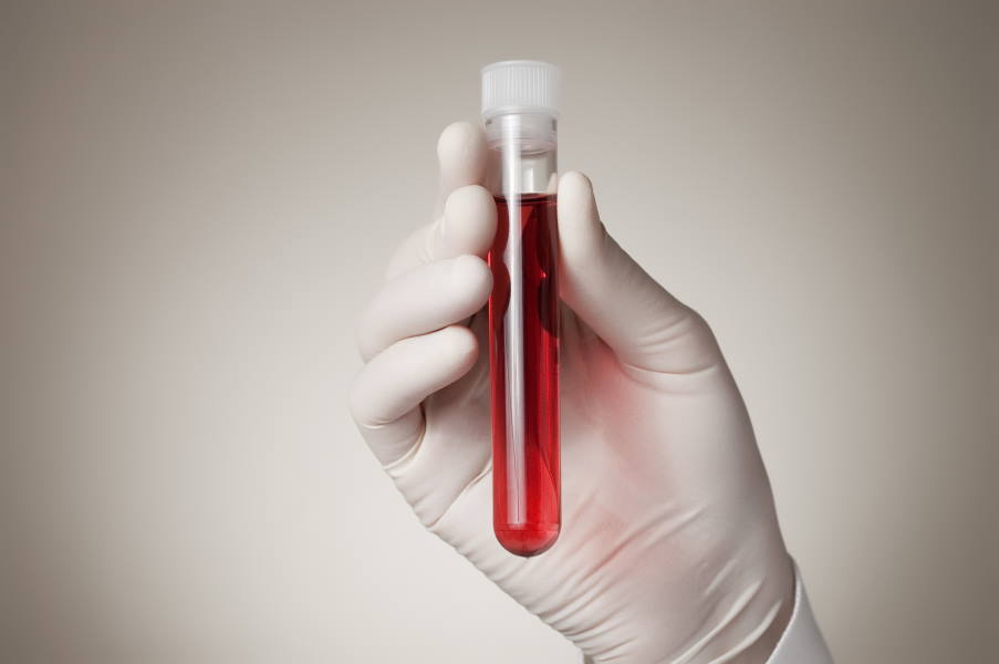 Νέο τεστ αίματος μπορεί να προβλέψει τον κίνδυνο εμφράγματος και εγκεφαλικού επεισοδίου