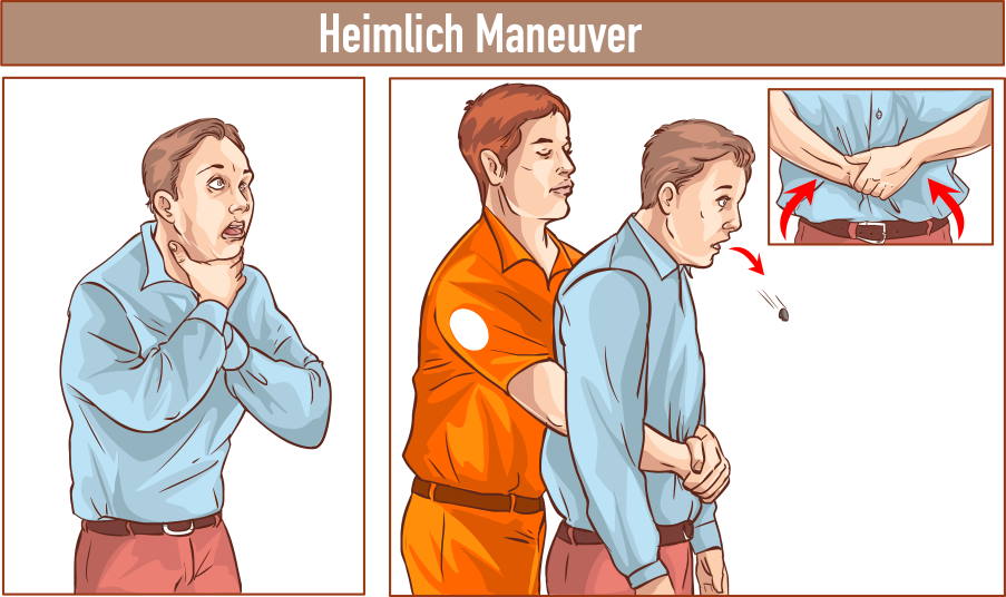 Mέθοδος Heimlich: Ποια είναι η λαβή που όλοι πρέπει να γνωρίζουμε και μπορεί να μας σώσει τη ζωή