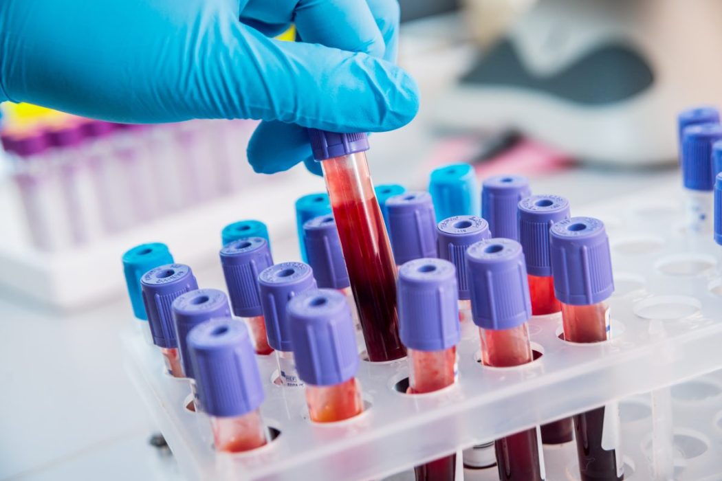 Ένα «έξυπνο» τεστ ανιχνεύει στο αίμα τον καρκίνο του ήπατος
